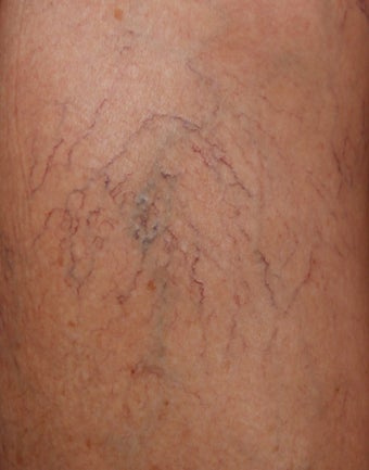 Sclerotherapy for Leg Veins before 1357681