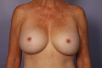 63 yr old Breast Revision after 957278
