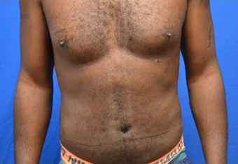 Male Liposuction of Abdomen and Waist after 1376358