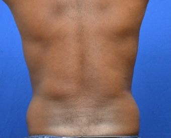 Male Liposuction of Abdomen and Waist 1376358