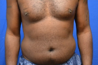 Male Liposuction of Abdomen and Waist before 1376358