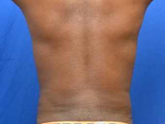 Male Liposuction of Abdomen and Waist 1376358