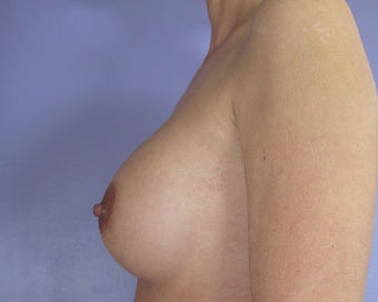 Breast Implant Correction after 281306