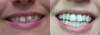 Invisalign before 1238568