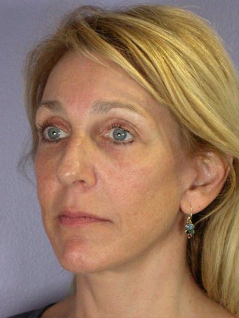 Eyelid Surgery after 280407