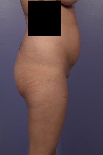 Buttock augmentation before 585018