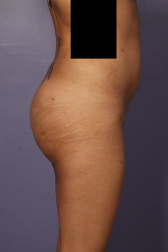 Buttock augmentation after 585018