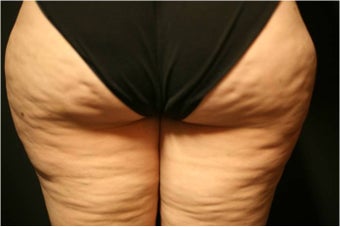 SmartLipo MPX before 686148