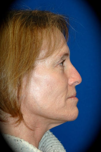 Laser Skin Resurfacing 1016141