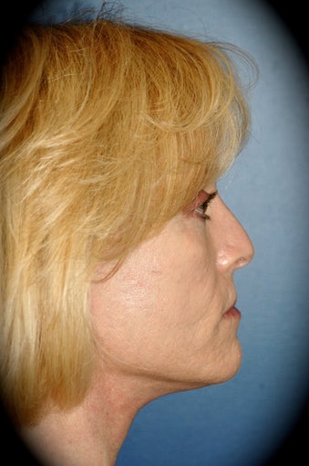 Laser Skin Resurfacing 1016141