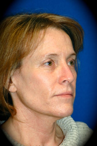 Laser Skin Resurfacing before 1016141