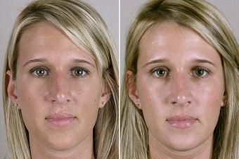Female Rhinoplasty before 922542