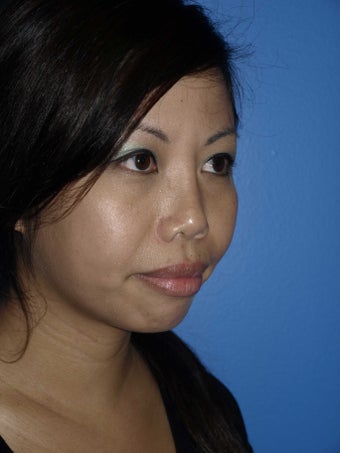 Revision Rhinoplasty with Chin Implant before 283304