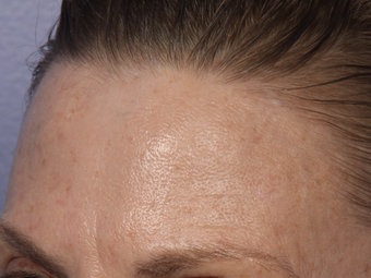 Limelight IPL to Forehead before 308350