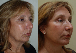 Neck Lift before 223588