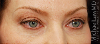 Eye Bag Surgery 887157