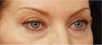 Eye Bag Surgery 887157