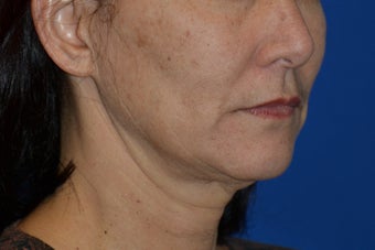 Ultherapy to cheeks and neck 939789