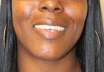 Dimple Creation after 598459