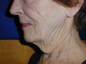 80 year old necklift before 652601