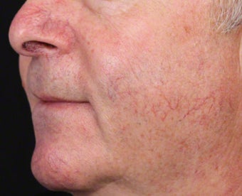 VBeam for Facial Veins before 539837