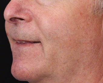 VBeam for Facial Veins after 539837