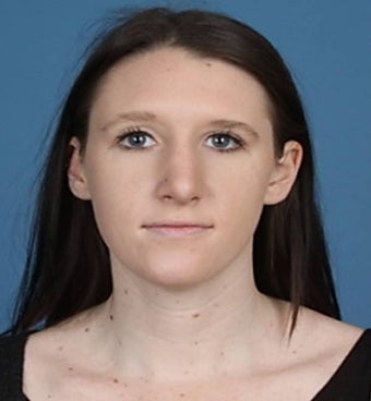 Rhinoplasty after 854053