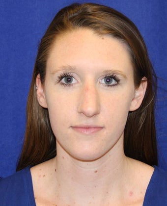 Rhinoplasty before 854053