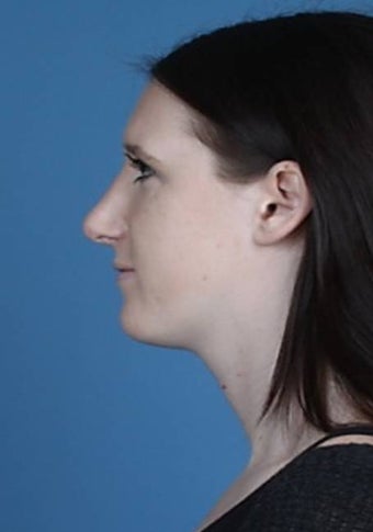 Rhinoplasty 854053