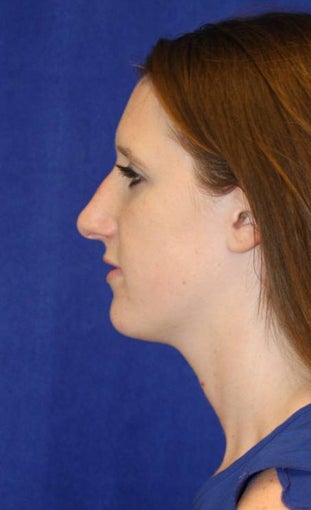 Rhinoplasty 854053