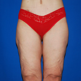 Thigh Lift after 945355