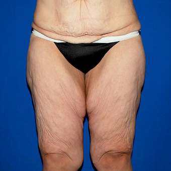 Thigh Lift before 945355