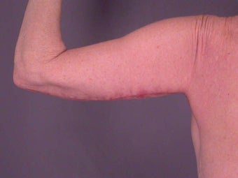 Arm Lift after 281287