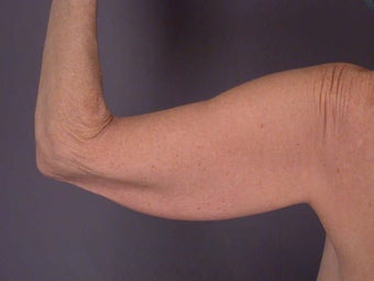 Arm Lift before 281287