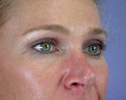 Eyelid Surgery after 280384