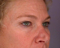 Eyelid Surgery before 280384