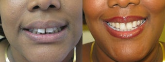 Invisalign (gap and overbite) before 1239580