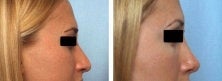 Rhinoplasty before 130771