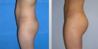 Butt Augmentation (Fat Transfer) before 257904