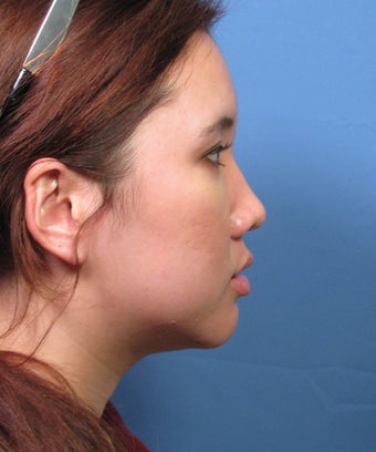 Asian Rhinoplasty Surgery Ethnic Rhinoplasty Example 895291