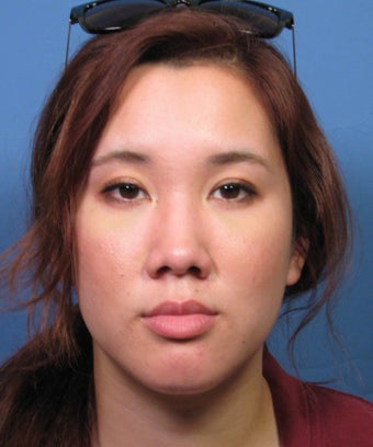 Asian Rhinoplasty Surgery Ethnic Rhinoplasty Example after 895291