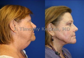 Neck liposuction and TCA chemical peel before 667236