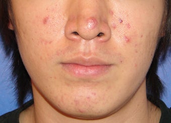 Photodynamic Therapy for Acne before 123686