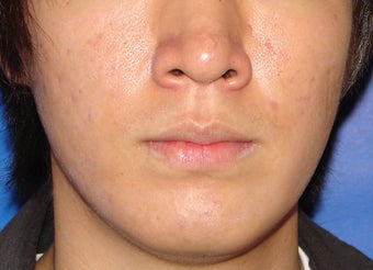 Photodynamic Therapy for Acne after 123686