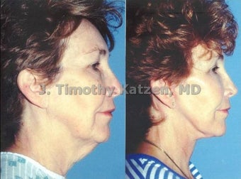 Neck lift and face lift after massive weight loss before 667228