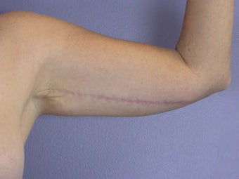 Arm Lift after 281285