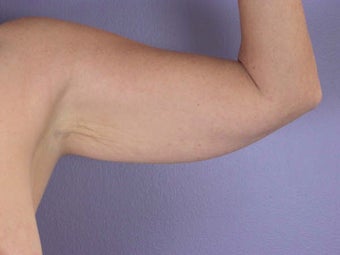 Arm Lift before 281285