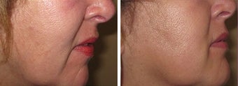 Juvederm/Fat Grafting before 718216