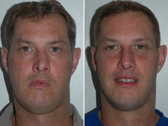 Revision Rhinoplasty before 228968