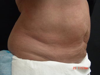 Coolsculpting before 542631